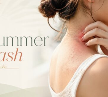 summer rash causes