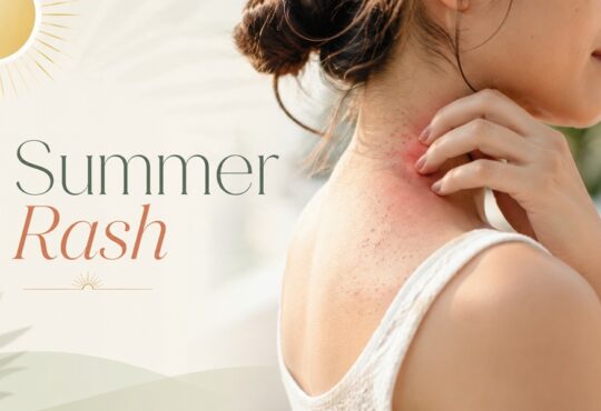 summer rash causes